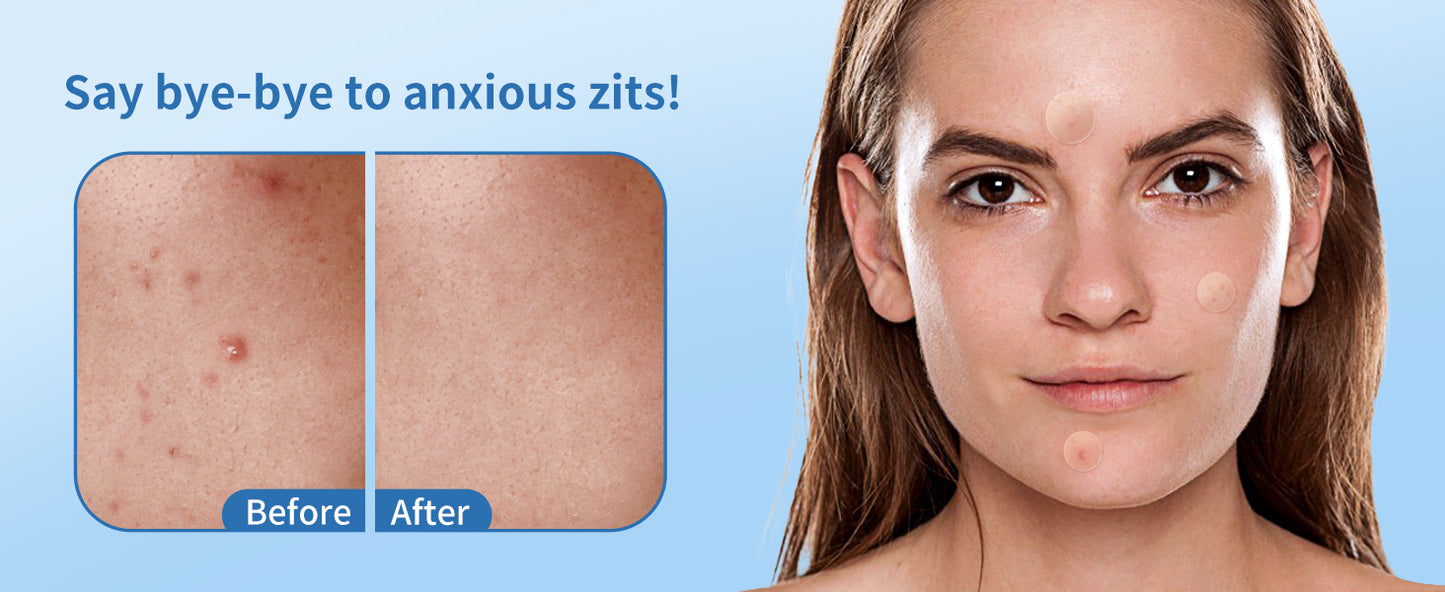 360-Piece Invisible Acne Patch Set for Effective Anti-Inflammatory Skin Care and Pimple Treatment